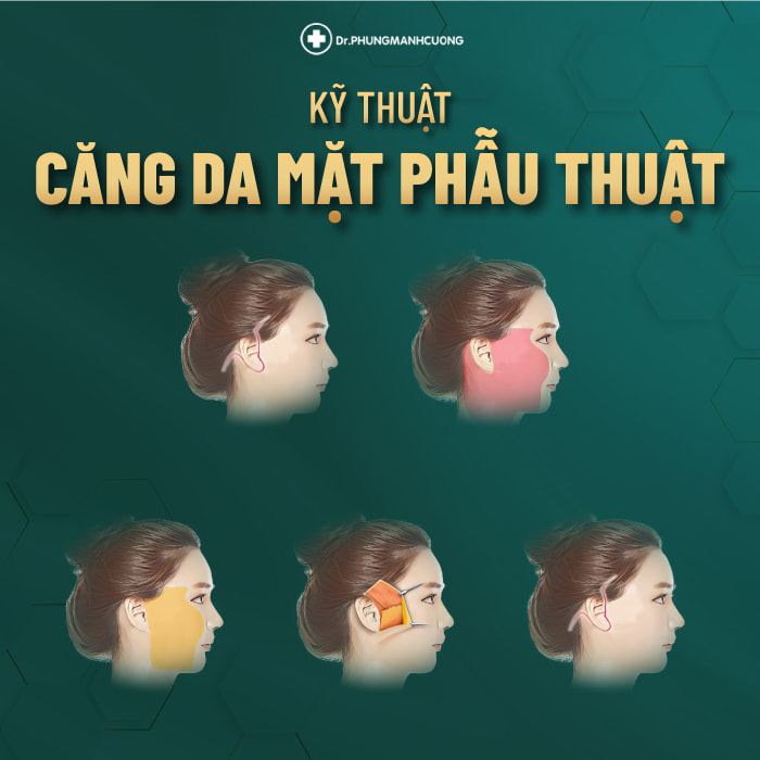 Phẫu thuật căng da mặt là phương pháp trẻ hoá phù hợp với mọi tình trạng lão hoá