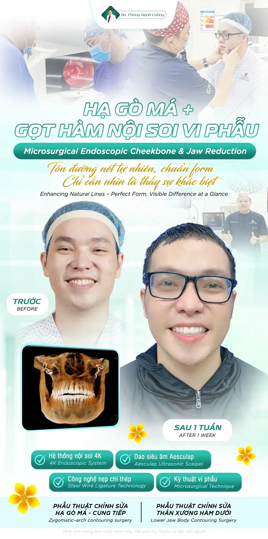 Tham khảo kết quả thực tế để lựa chọn cơ sở hạ gò má uy tín