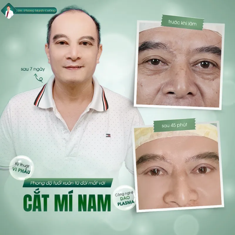 Cắt mí nam là gì? Cắt mắt 2 mí cho nam giới giá bao nhiêu? 25 Hiện nay có nhiều kỹ thuật cắt mắt 2 mí cho nam đẹp tự nhiên
