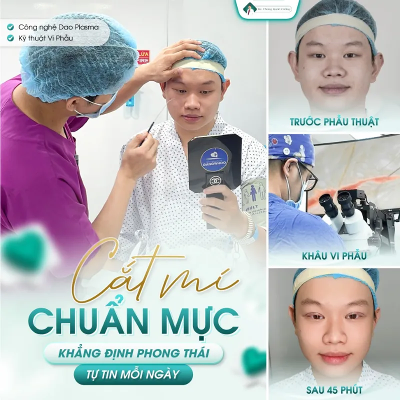 Cắt mí nam là gì? Cắt mắt 2 mí cho nam giới giá bao nhiêu? 26 Cắt mí mắt cho nam giới bằng dao plasma