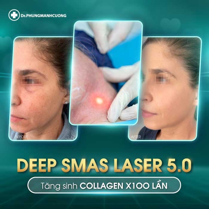 Deep Smas Laser 5.0 là phương pháp căng da mặt hiện đại nhất hiện nay 