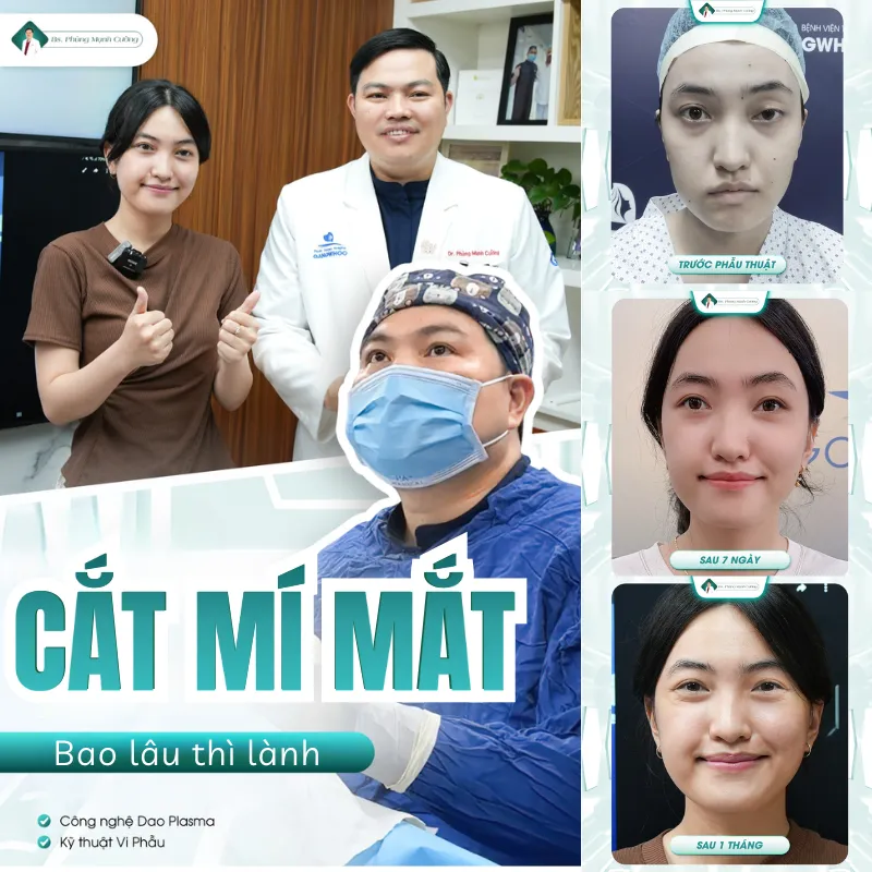 Cắt mí bao lâu thì lành? Hướng dẫn cách chăm sóc sau cắt mí 9 Tìm hiểu cắt mí bao lâu thì lành và đẹp tự nhiên