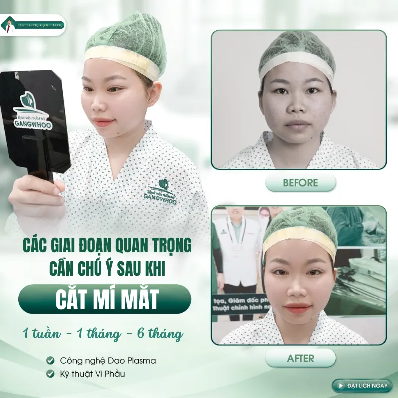 Cắt mí bao lâu thì lành? Hướng dẫn cách chăm sóc sau cắt mí 10 Các giai đoạn phục hồi sau khi cắt mí mắt