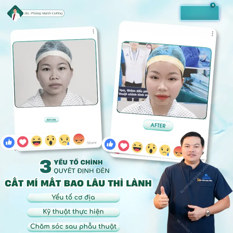 Cắt mí bao lâu thì lành? Hướng dẫn cách chăm sóc sau cắt mí 12 Các yếu tố chính ảnh hưởng đến thời gian phục hồi sau khi cắt mí