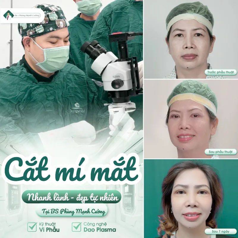 Cắt mí bao lâu thì lành? Hướng dẫn cách chăm sóc sau cắt mí 14 Địa chỉ cắt mí an toàn, mau lành và thẩm mỹ cao