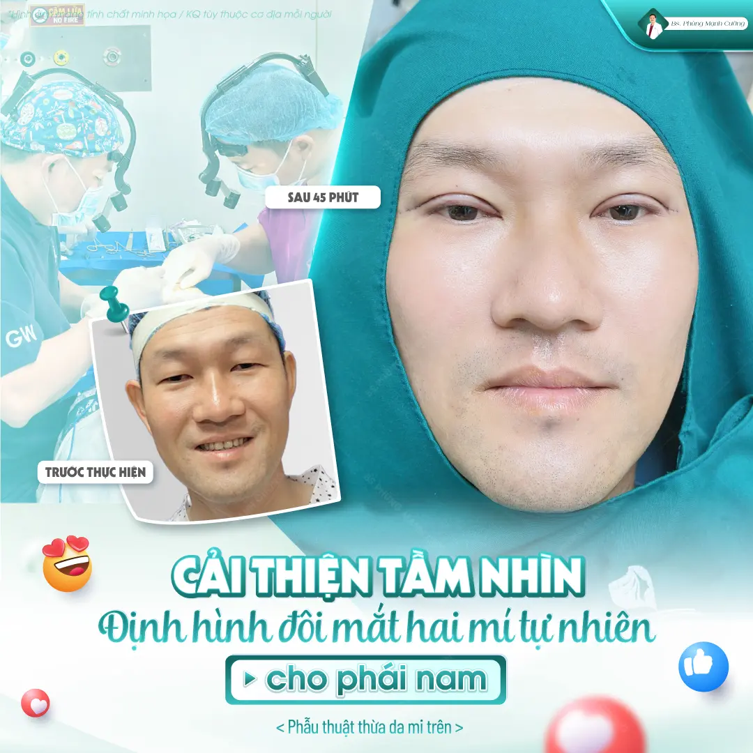 Những lý do nam giới nên cắt mí