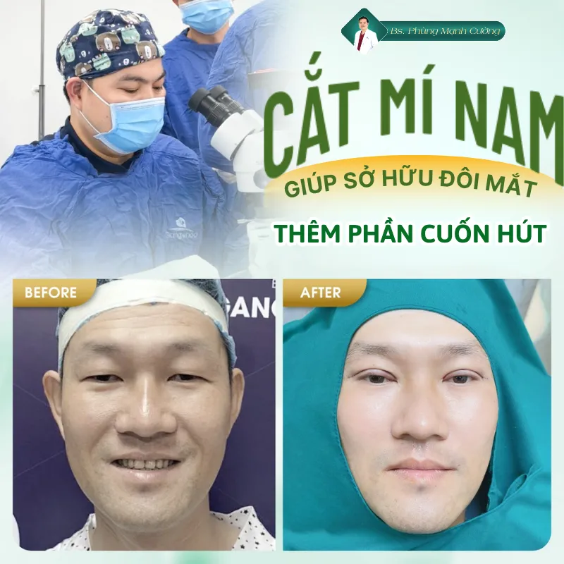 Cắt mí nam là gì? Cắt mắt 2 mí cho nam giới giá bao nhiêu? 29 Cắt mí mắt thường duy trì nếp mí từ 10-15 năm