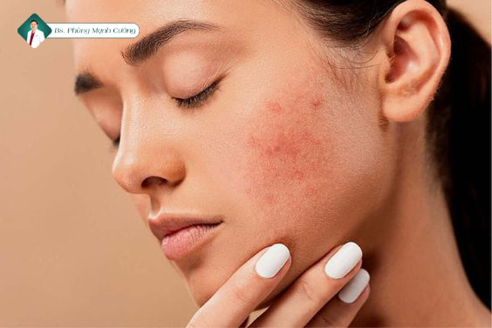 Kích ứng da - Rủi ro thường gặp sau khi tiêm căng bóng da mặt