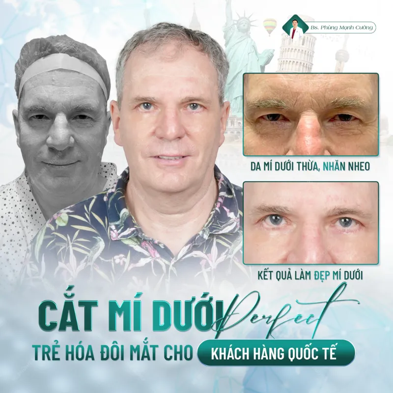 Cắt mí bao nhiêu tiền? Giá cắt mí mắt mới nhất hiện nay 40 Hình ảnh khách hàng cắt mí dưới perfect tại bác sĩ Cường