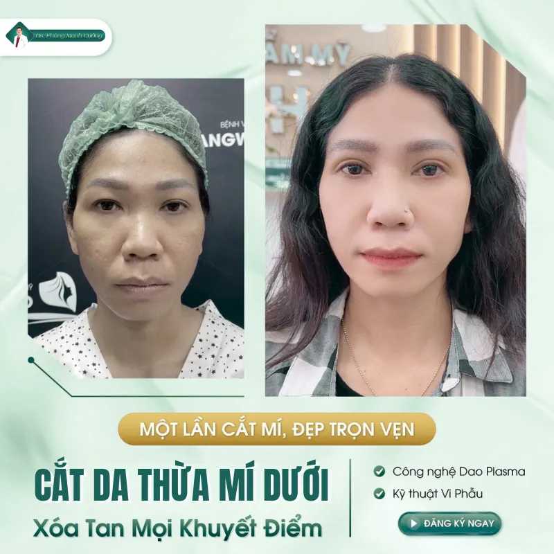 Phẫu thuật cắt da thừa mí mắt và những điều cần biết 25 Cắt da dư mí mắt khá an toàn nếu được thực hiện tại cơ sở uy tín