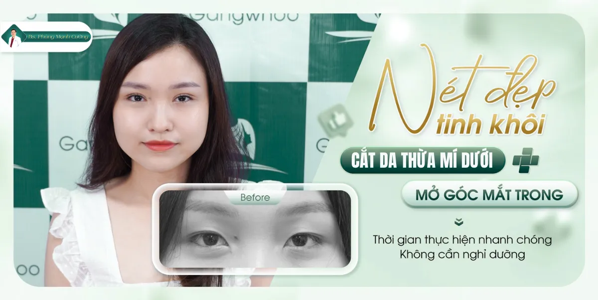 Phẫu thuật cắt da thừa mí mắt và những điều cần biết 21 Những trường hợp nên thực hiện phẫu thuật cắt da dư mí mắt