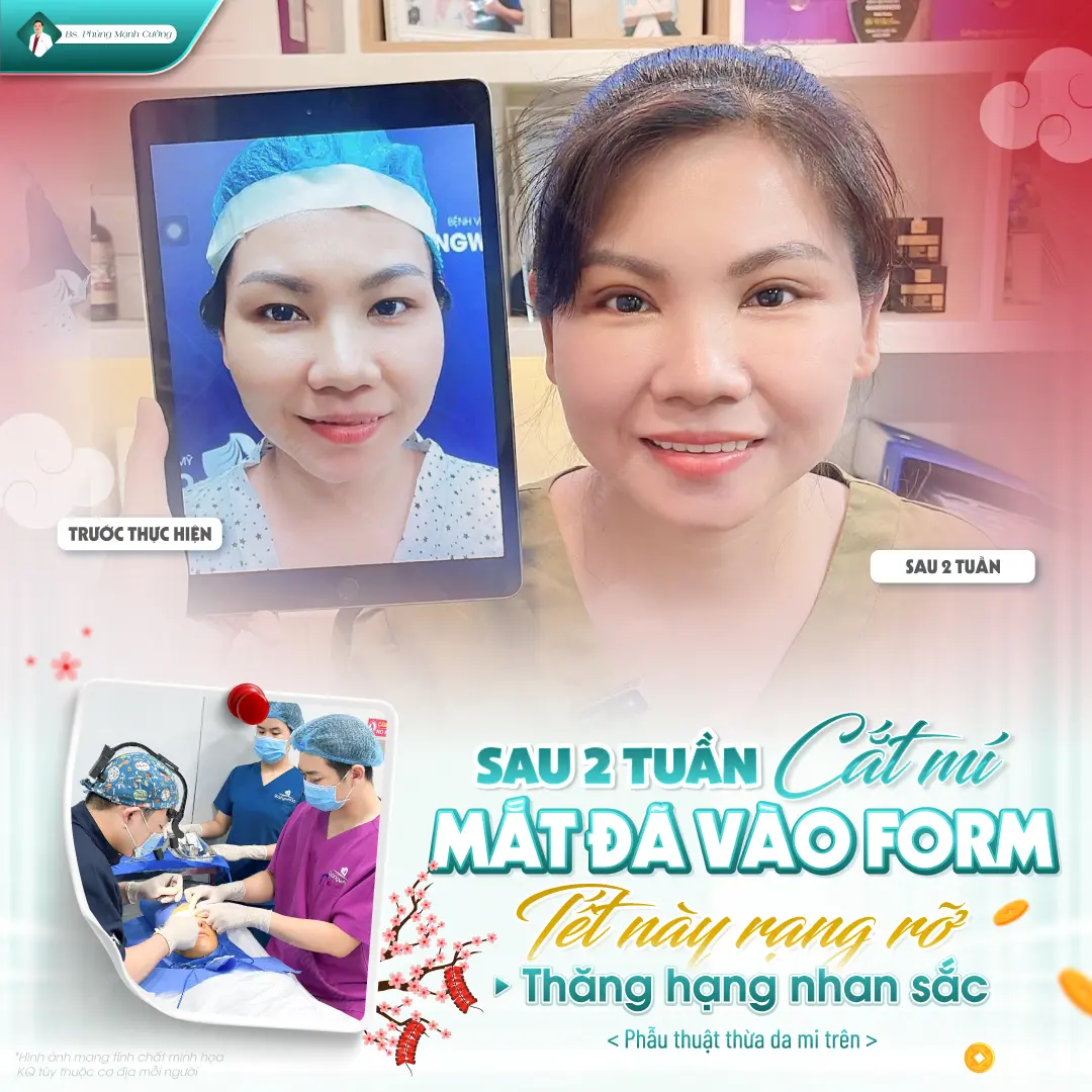 Các giai đoạn phục hồi sau cắt mí