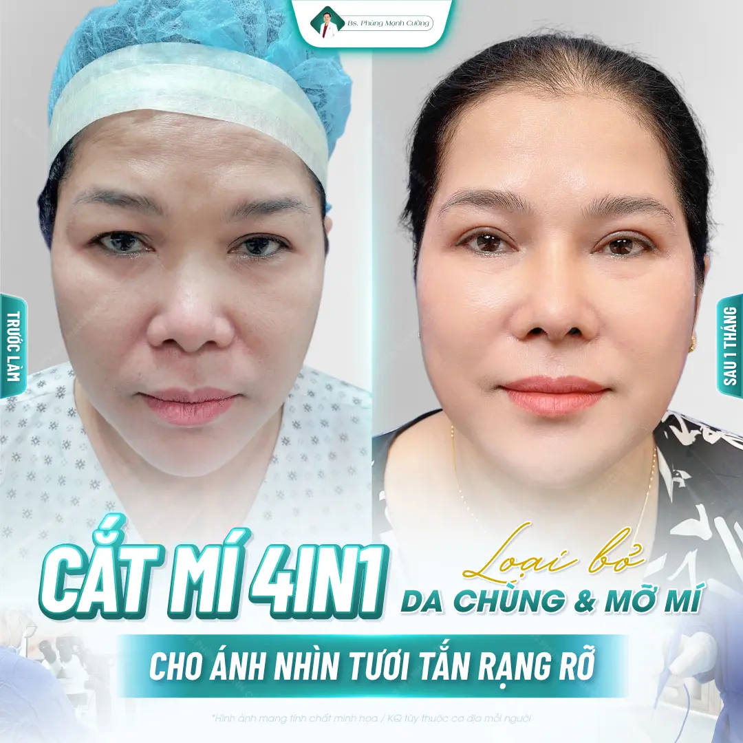 Tầm quan trọng của chăm sóc hậu phẫu cắt mí