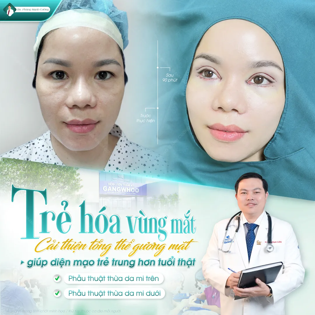 Những ai nên thực hiện cắt mí mắt 1 bên