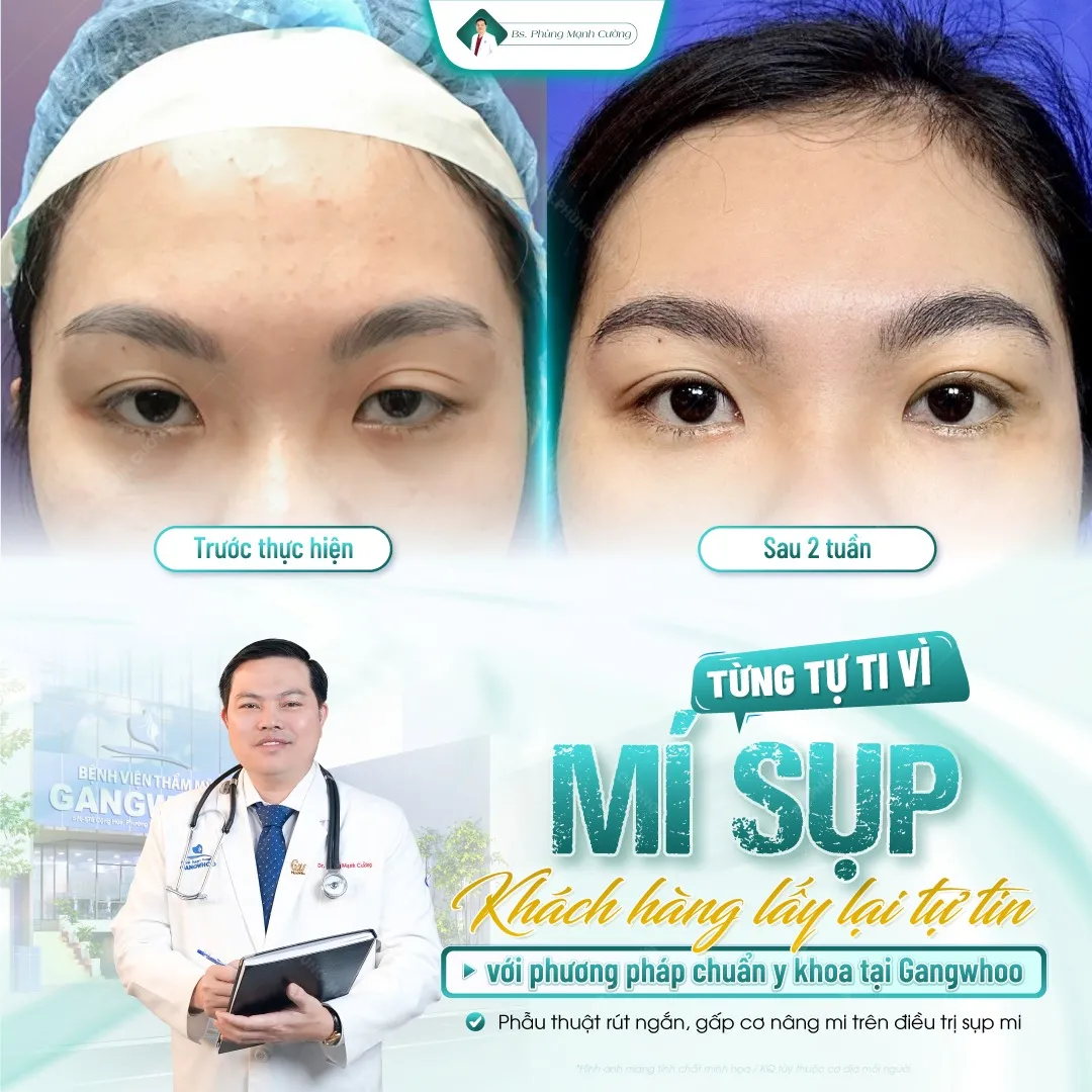 Cắt mí mắt 1 bên khắc phục mí sụp hiệu quả