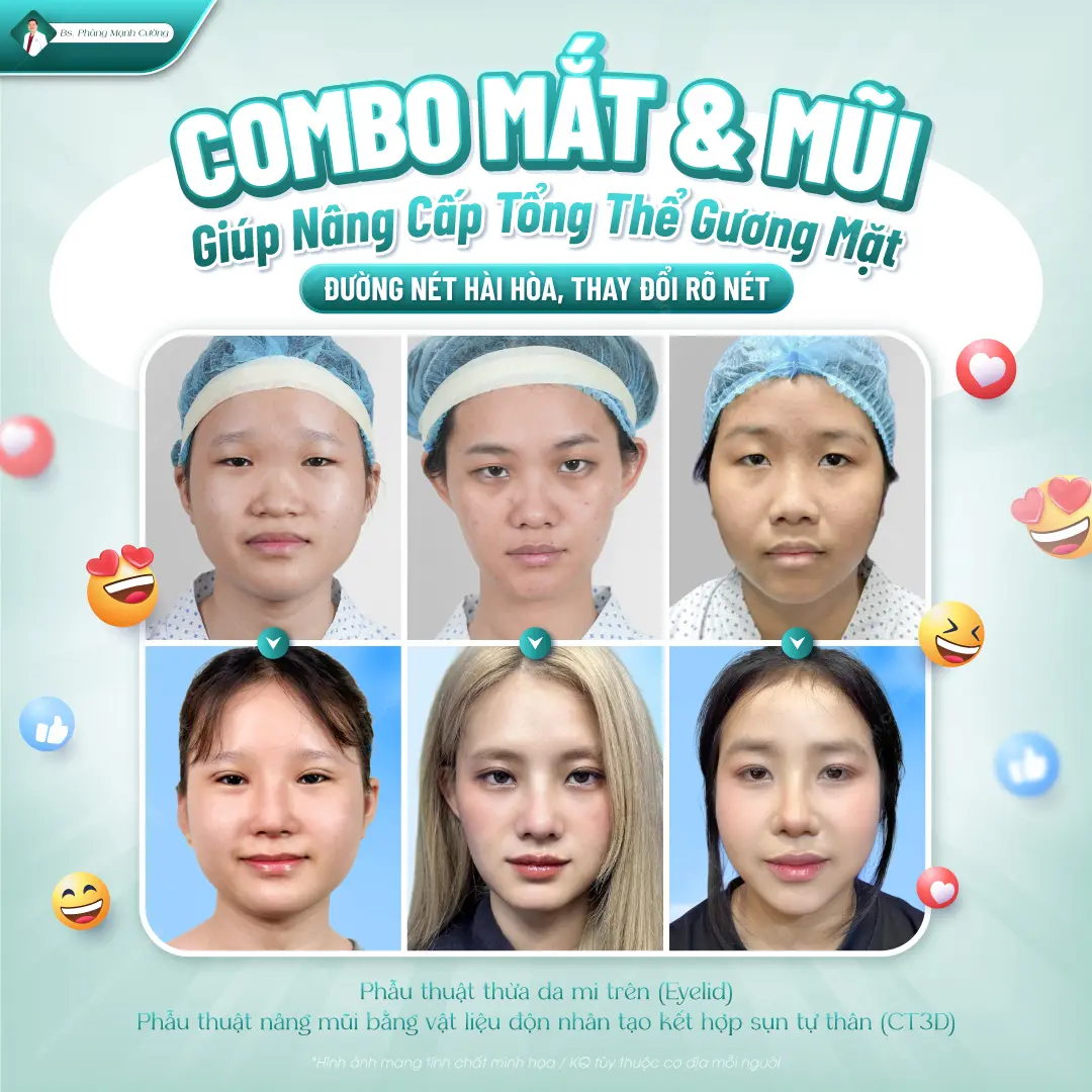Combo nâng mũi - cắt mí và những điều cần biết