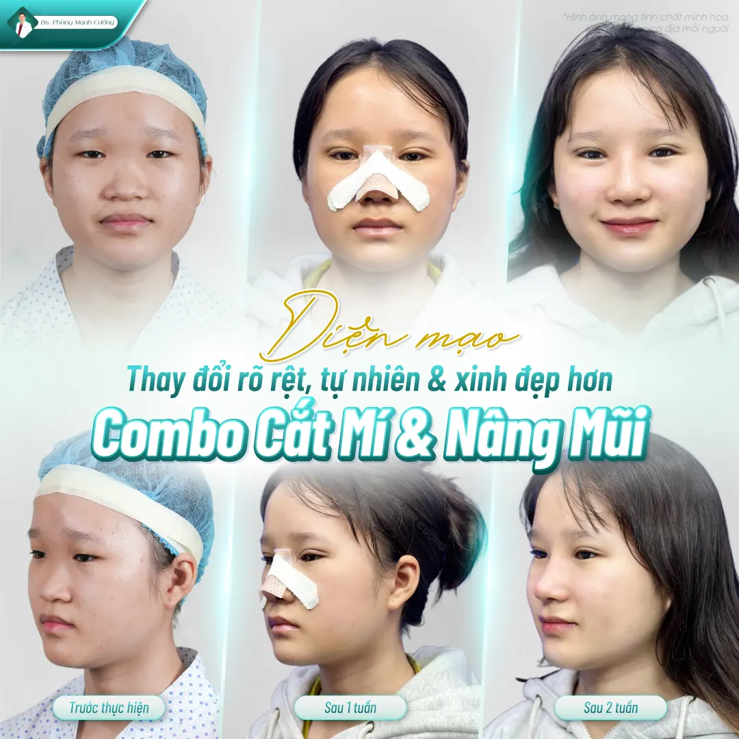Combo nâng mũi và cắt mí tại bác sĩ Phùng Mạnh Cường 