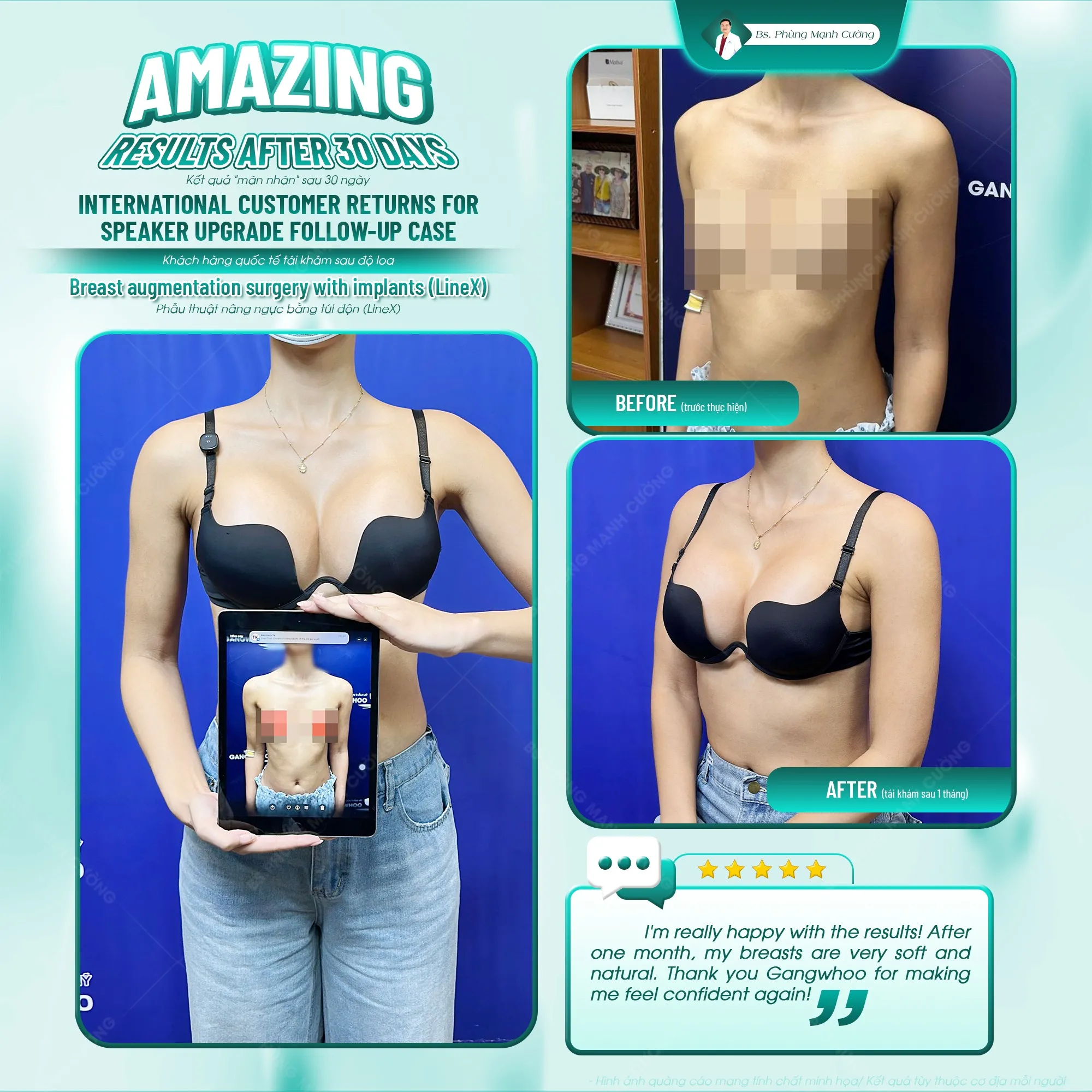 Sau 4-6 tuần nâng ngực, bạn có thể sinh hoạt bình thường