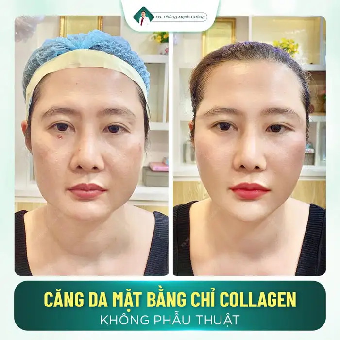Căng Chỉ Collagen Có Tác Dụng Phụ Không? Có An Toàn Không? 10 Căng chỉ collagen có thể gặp một số tác dụng phụ do kỹ thuật thực hiện không đúng