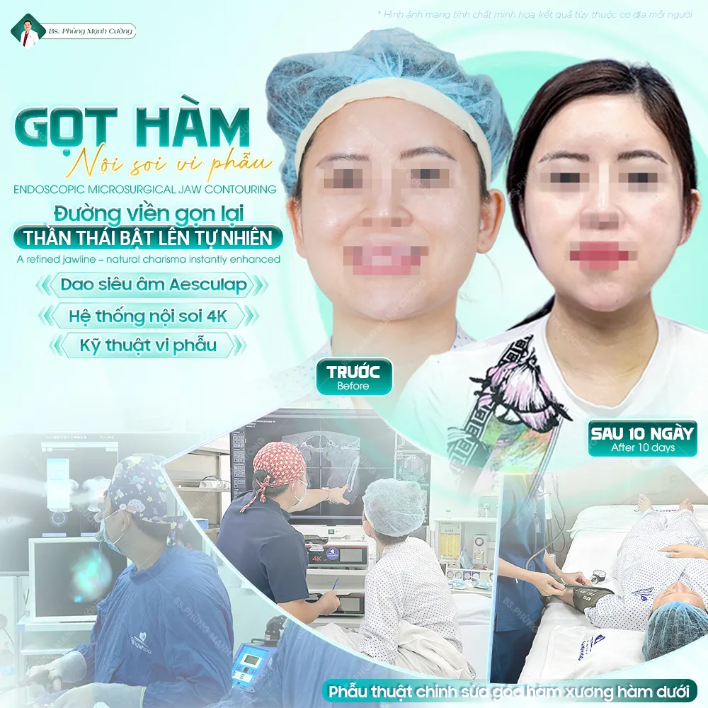 Gọt hàm sau bao lâu thì hết tê? Cách chăm sóc phục hồi hiệu quả 11 Cảm giác tê sau gọt hàm thường giảm dần trong khoảng 7–10 ngày