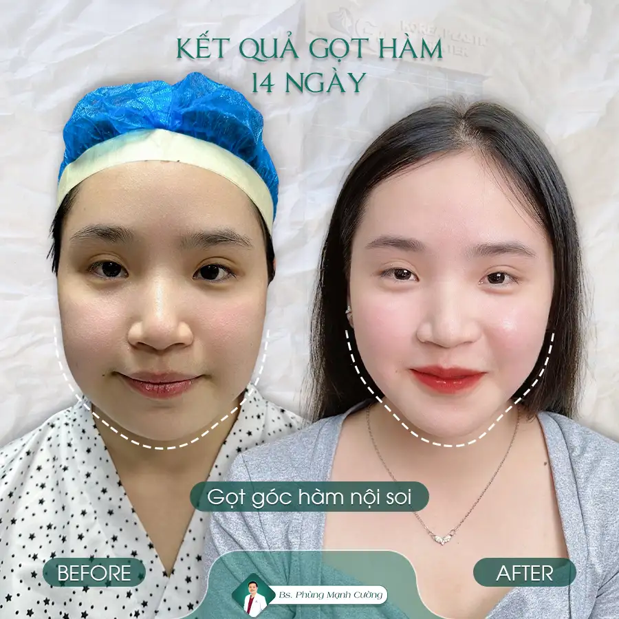 Gọt Hàm Sau Bao Lâu Thì Hết Tê? Địa Chỉ Gọt Hàm Uy Tín