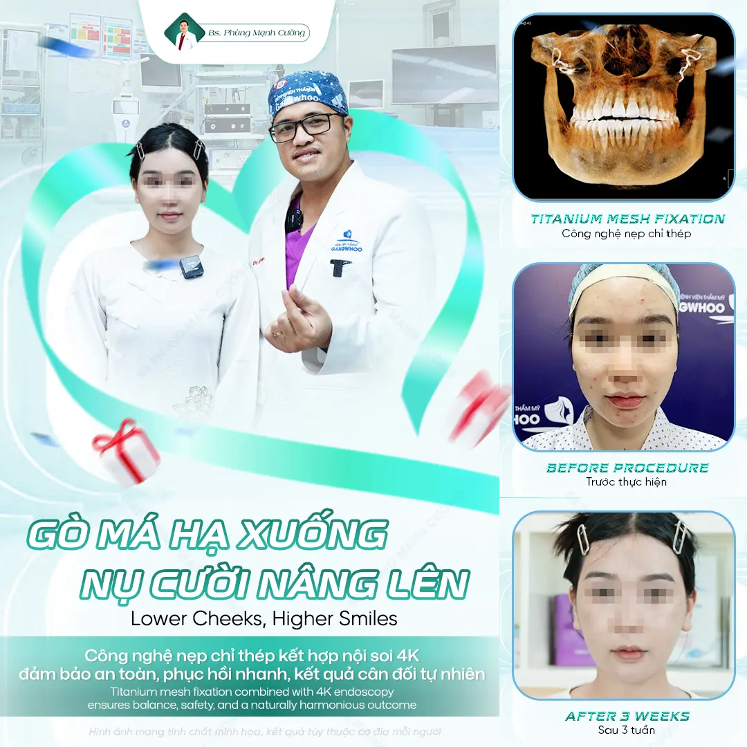 Phẫu Thuật Hạ Gò Má Bao Lâu Thì Được Nhai? 10 Khoảng từ 4–6 tuần sau phẫu thuậ hạ gò má, bạn có thể nhai được