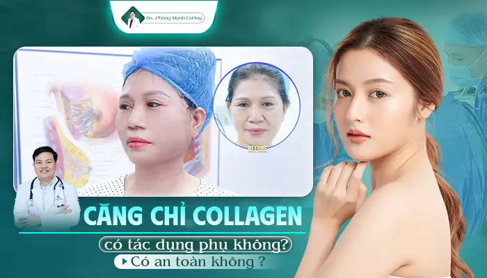 Căng Chỉ Collagen Có Tác Dụng Phụ Không? Có An Toàn Không? 9 Căng chỉ collagen có tác dụng phụ không?