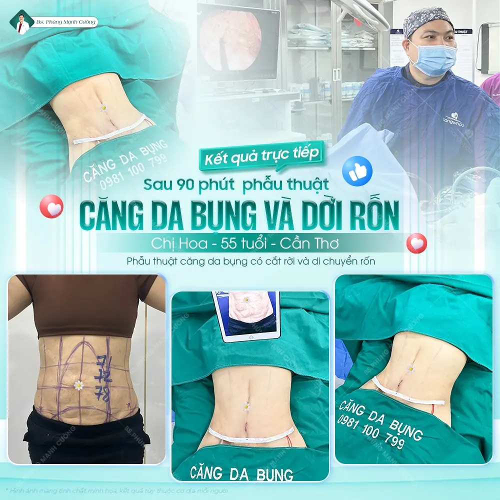 Những lý do nên căng da bụng