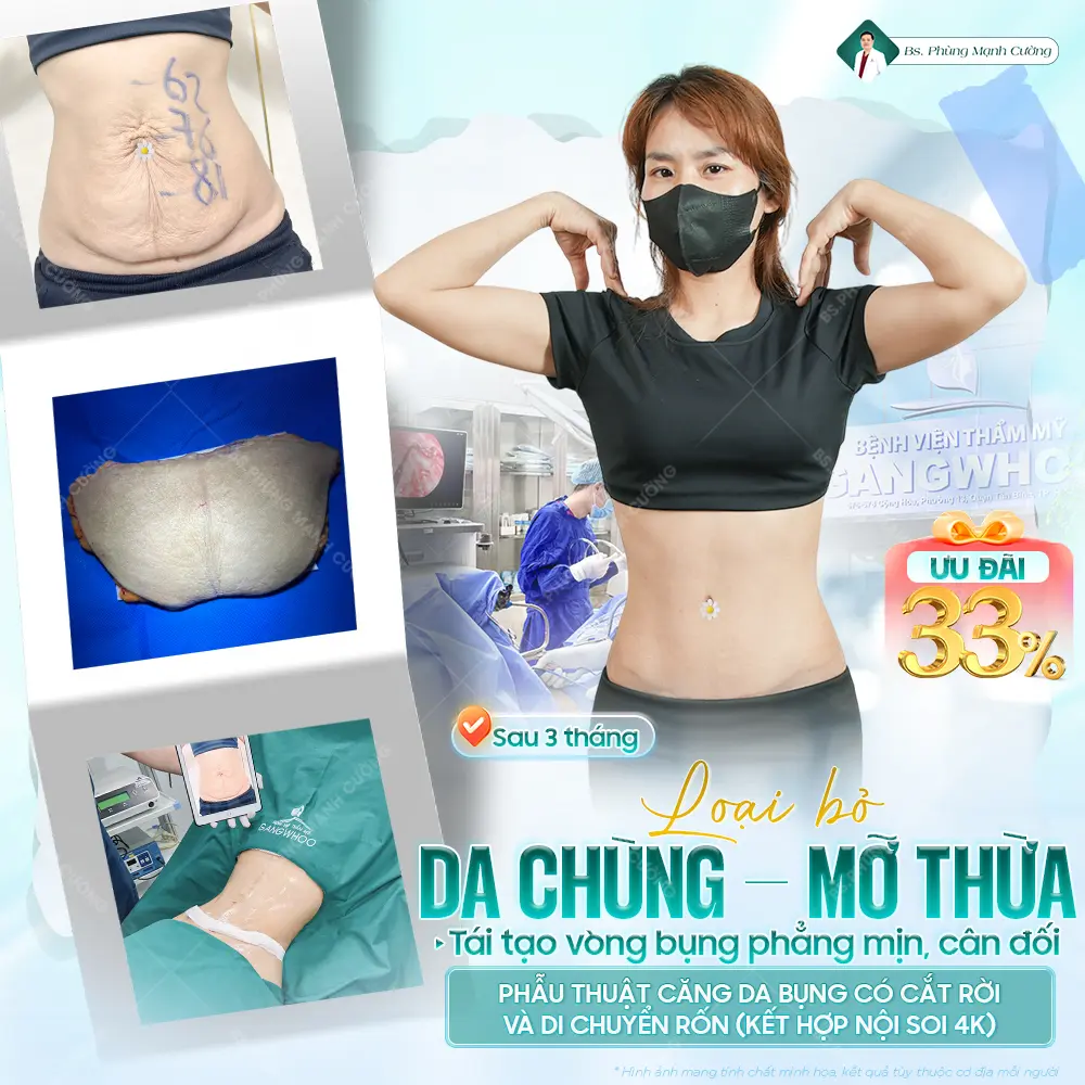 Đối tượng phù hợp để căng da bụng