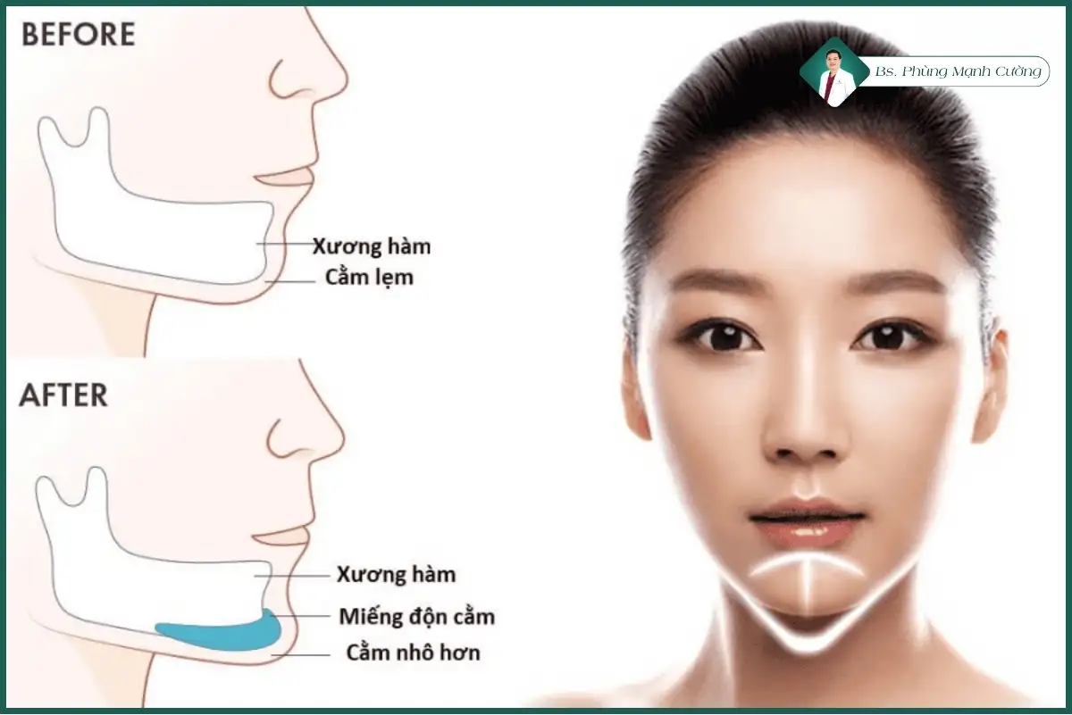 Độn cằm bằng sụn nhân tạo