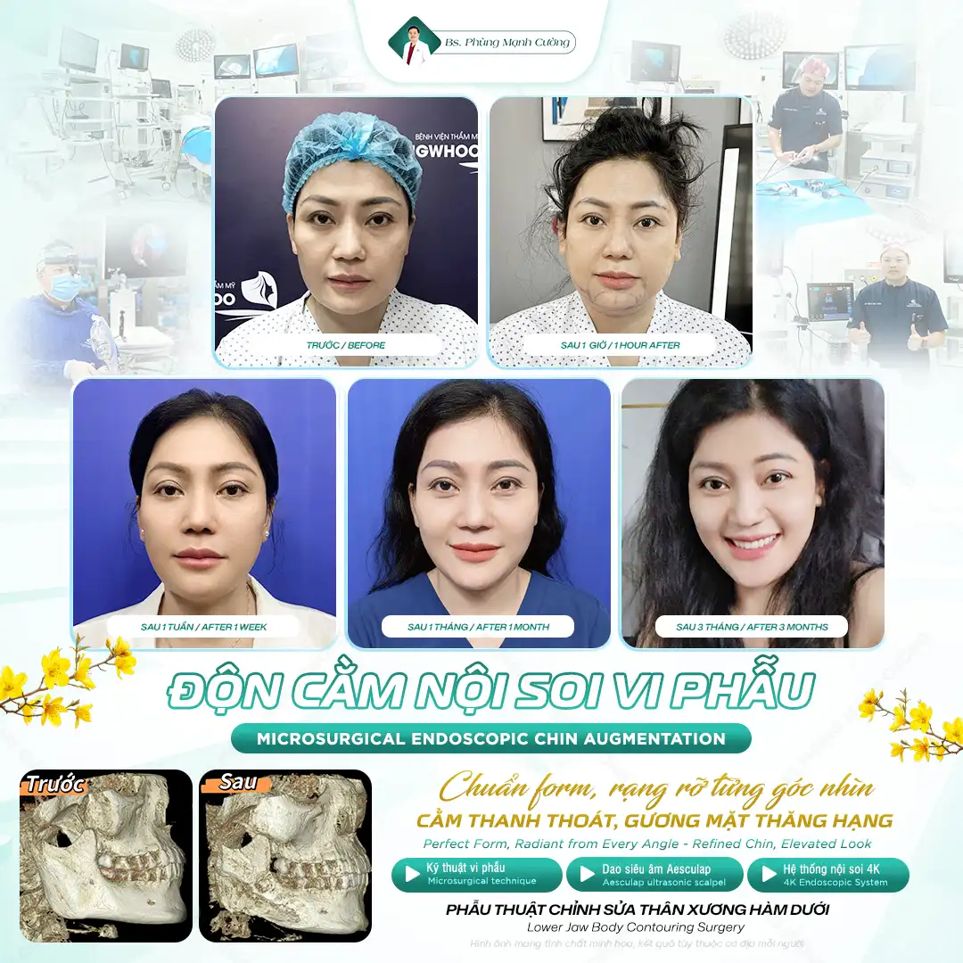 Chi phí phẫu thuật độn cằm dao động từ 20 đến 60 triệu đồng