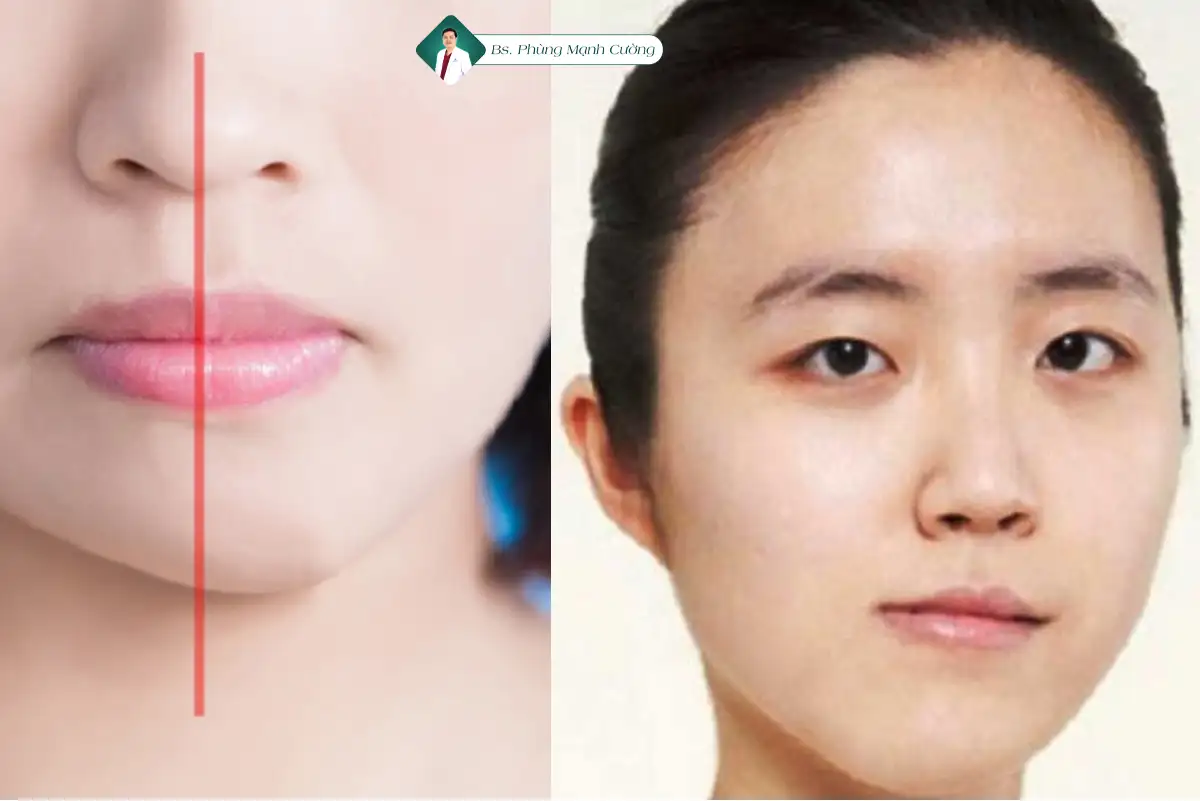 Độn Cằm Giá Bao Nhiêu? Giá Độn Cằm Mới Nhất 12 Một số biến chứng khi độn cằm giá rẻ