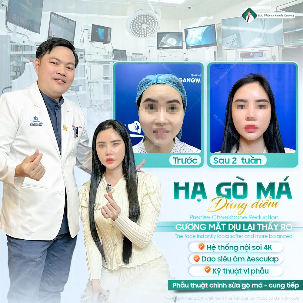 Sau phẫu thuật hạ gò má không bắt buộc phải tiêm mỡ