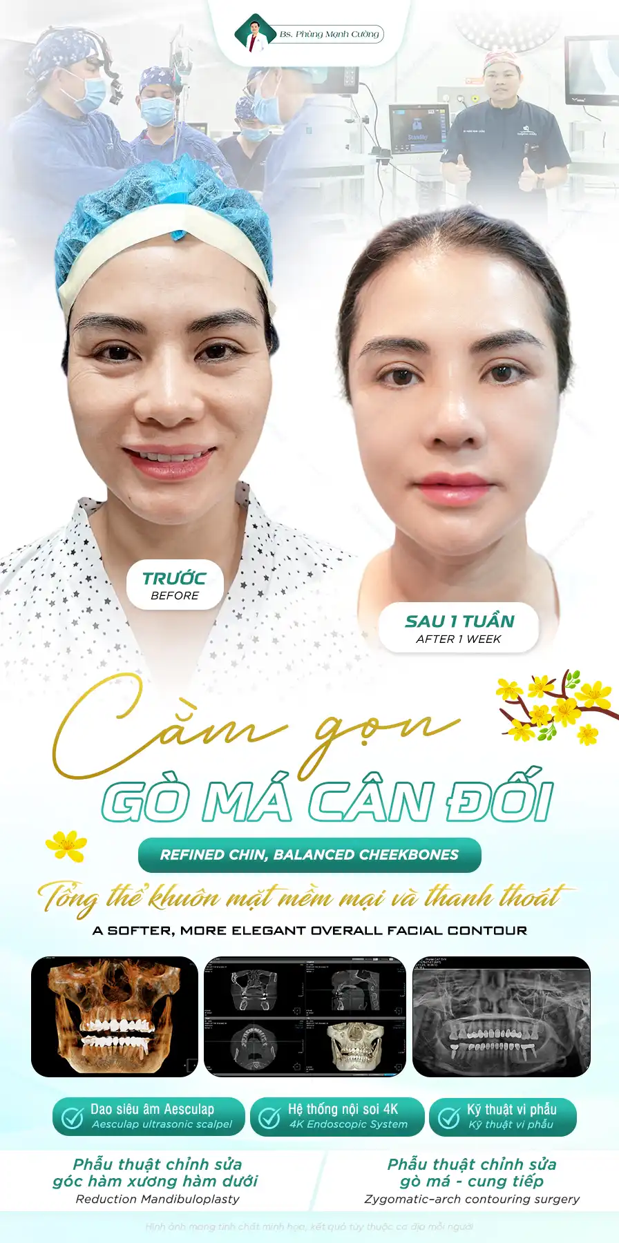 Hạ gò má tại bác sĩ Phùng Mạnh Cường đảm bảo an toàn và thẩm mỹ