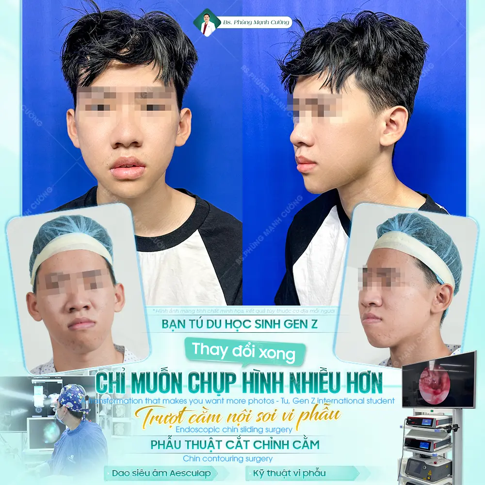 Kết Quả Phẫu Thuật Trượt Cằm Có Vĩnh Viễn Không? 9 Kết quả trượt cằm có thể kéo dài vĩnh viễn