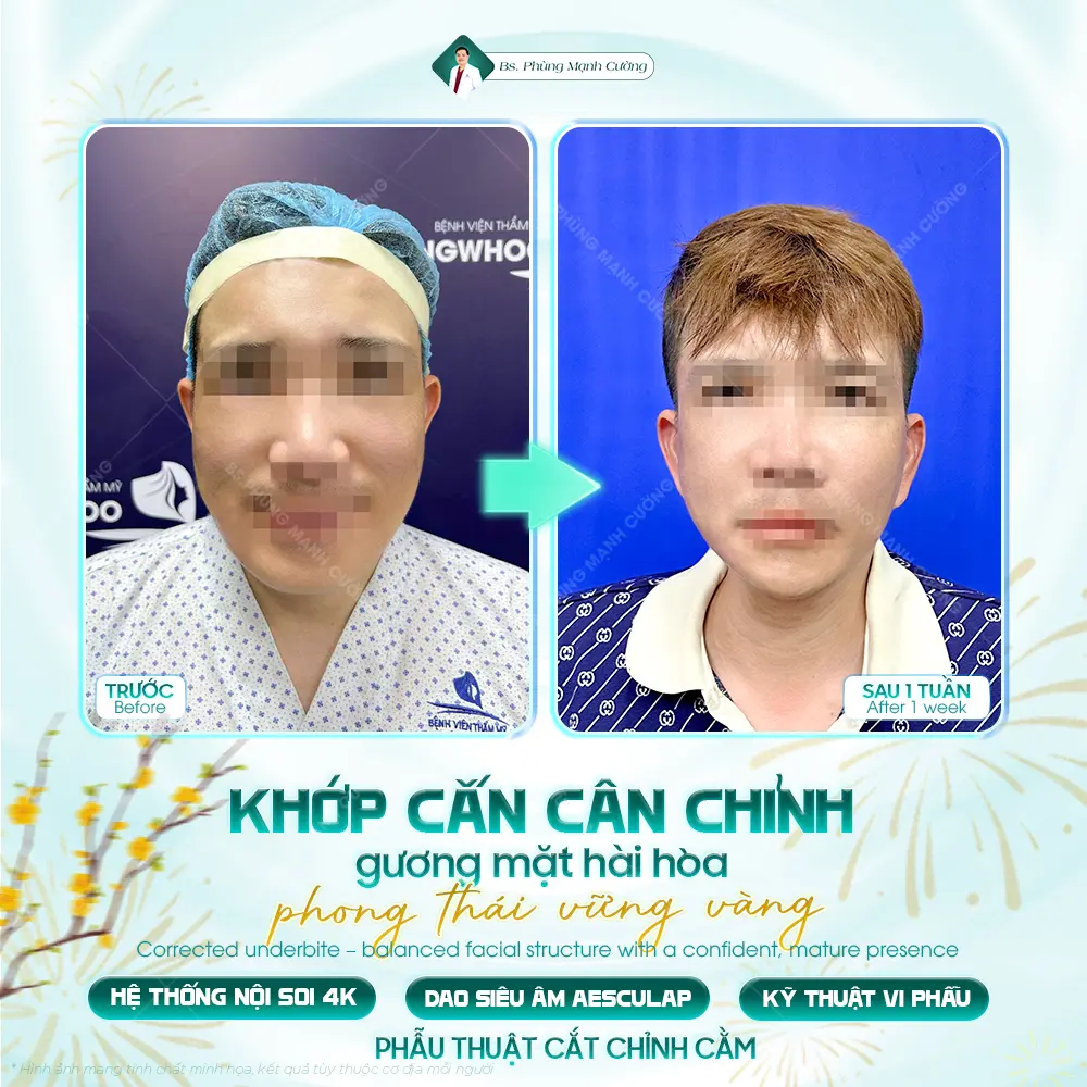 Chi phí cho một ca phẫu thuật trượt cằm thường dao động từ 50 triệu đến 150 triệu đồng