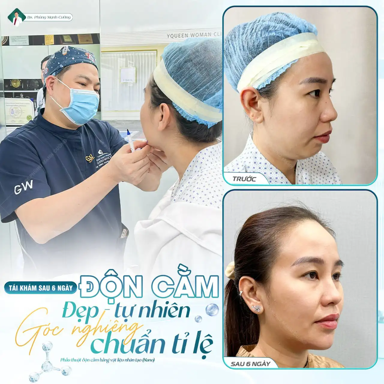 Có nên độn cằm không? Ưu điểm và đối tượng phù hợp 9 Bác sĩ tư vấn có nên độn cằm không