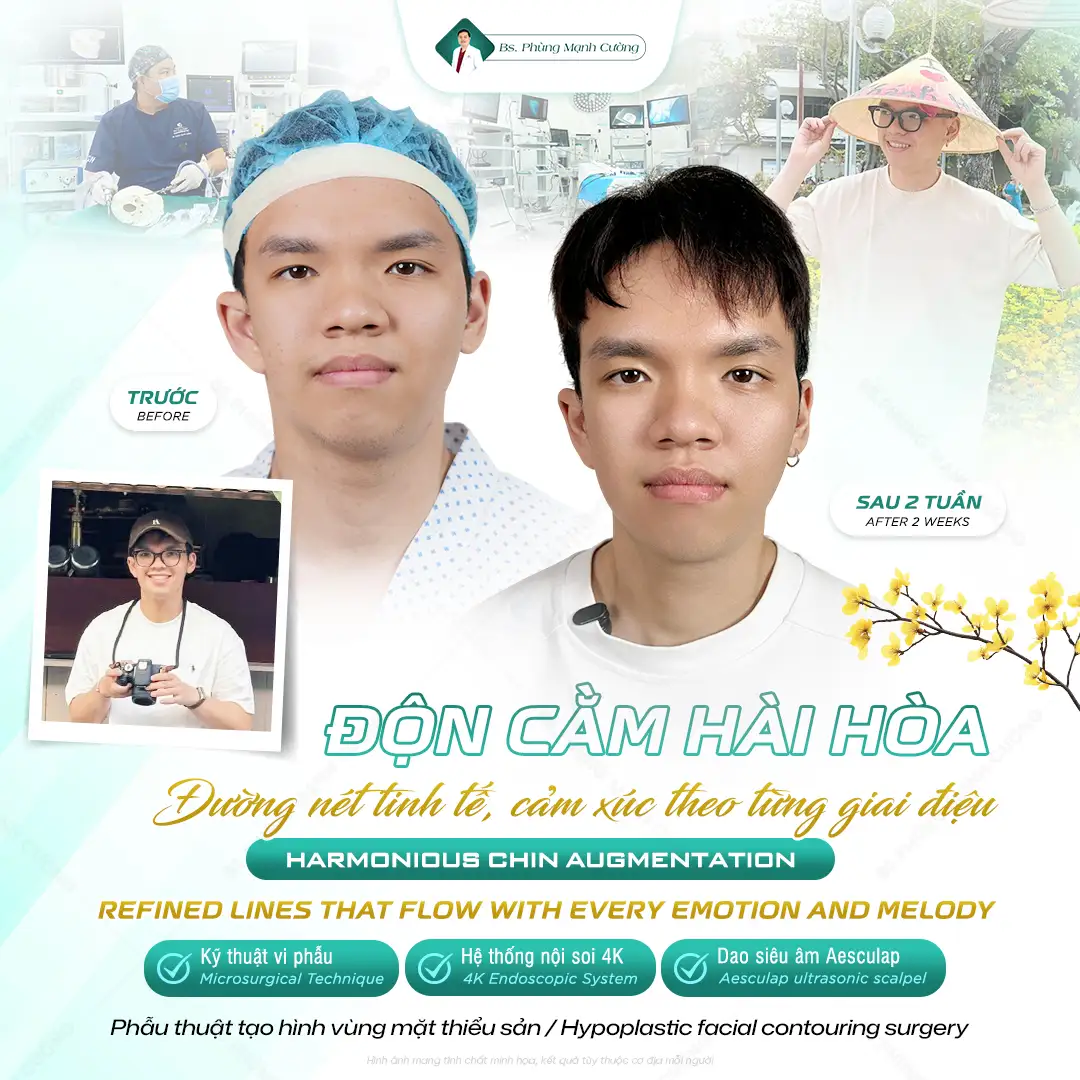 Có nên độn cằm không? Ưu điểm và đối tượng phù hợp 11 Độn cằm tại bác sĩ Phùng Mạnh Cường - chuyên gia hơn 15 năm kinh nghiệm