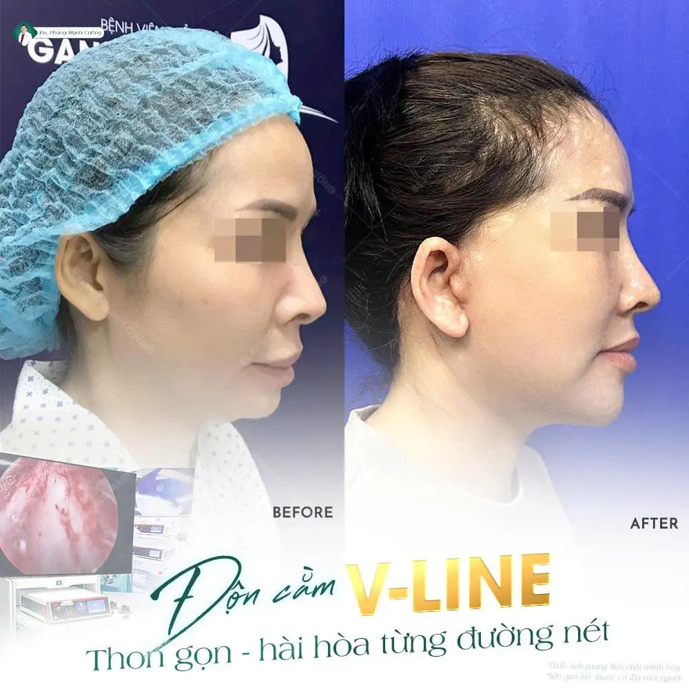 Cơ địa mỗi khách hàng có ảnh hưởng đến thời gian hồi phục