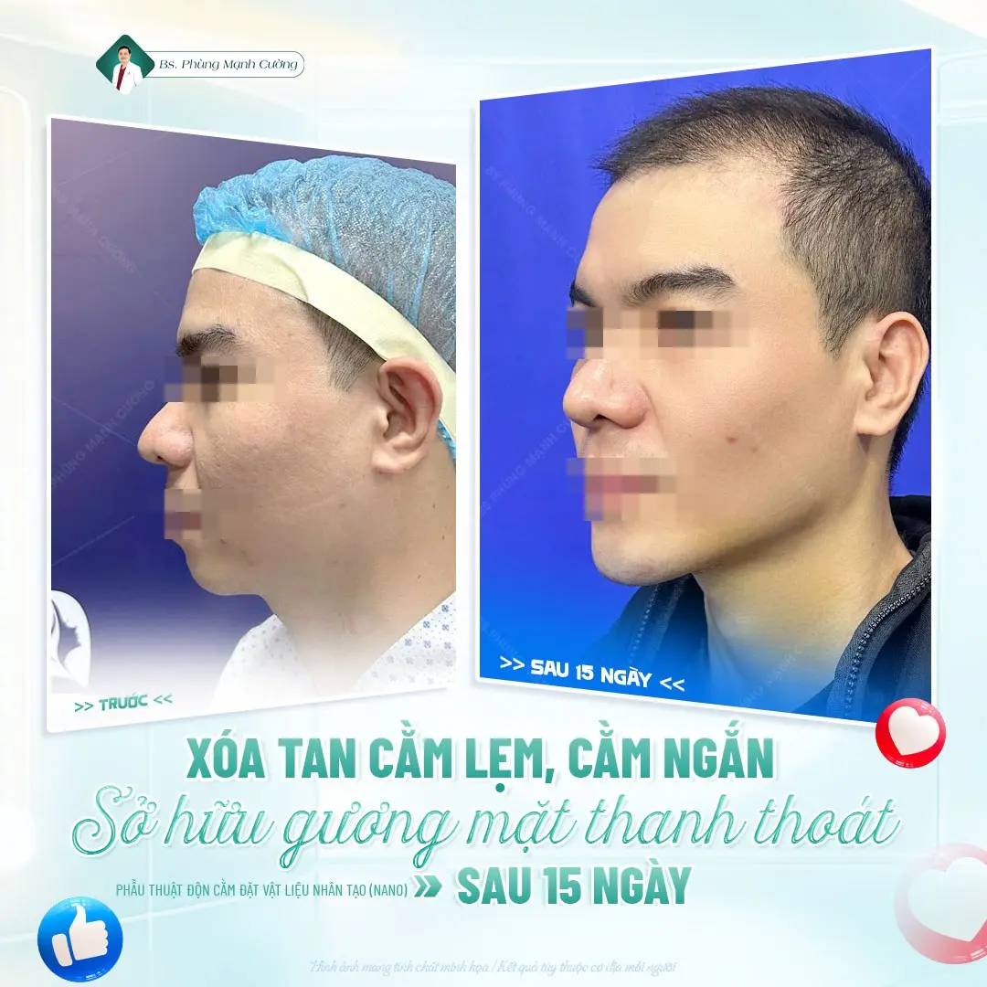 Nam giới hoàn toàn có thể thực hiện phẫu thuật độn cằm để cải thiện diện mạo