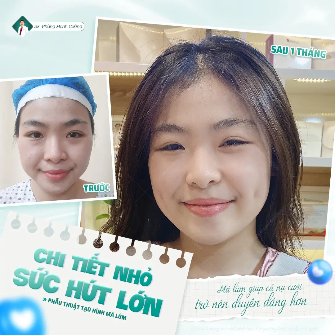 Tìm hiểu phẫu thuật tạo má lúm đồng tiền