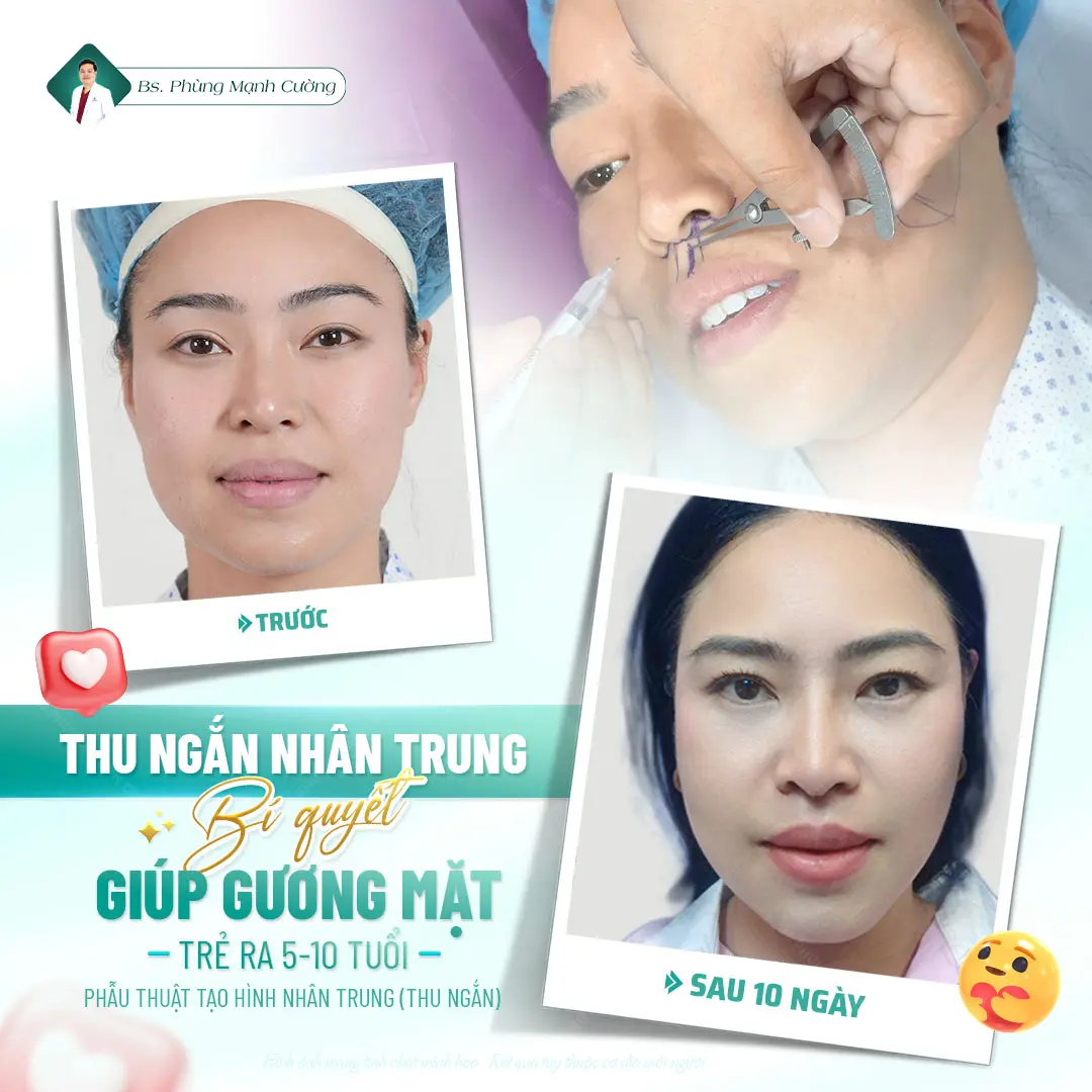 Ưu điểm của phẫu thuật thu ngắn nhân trung