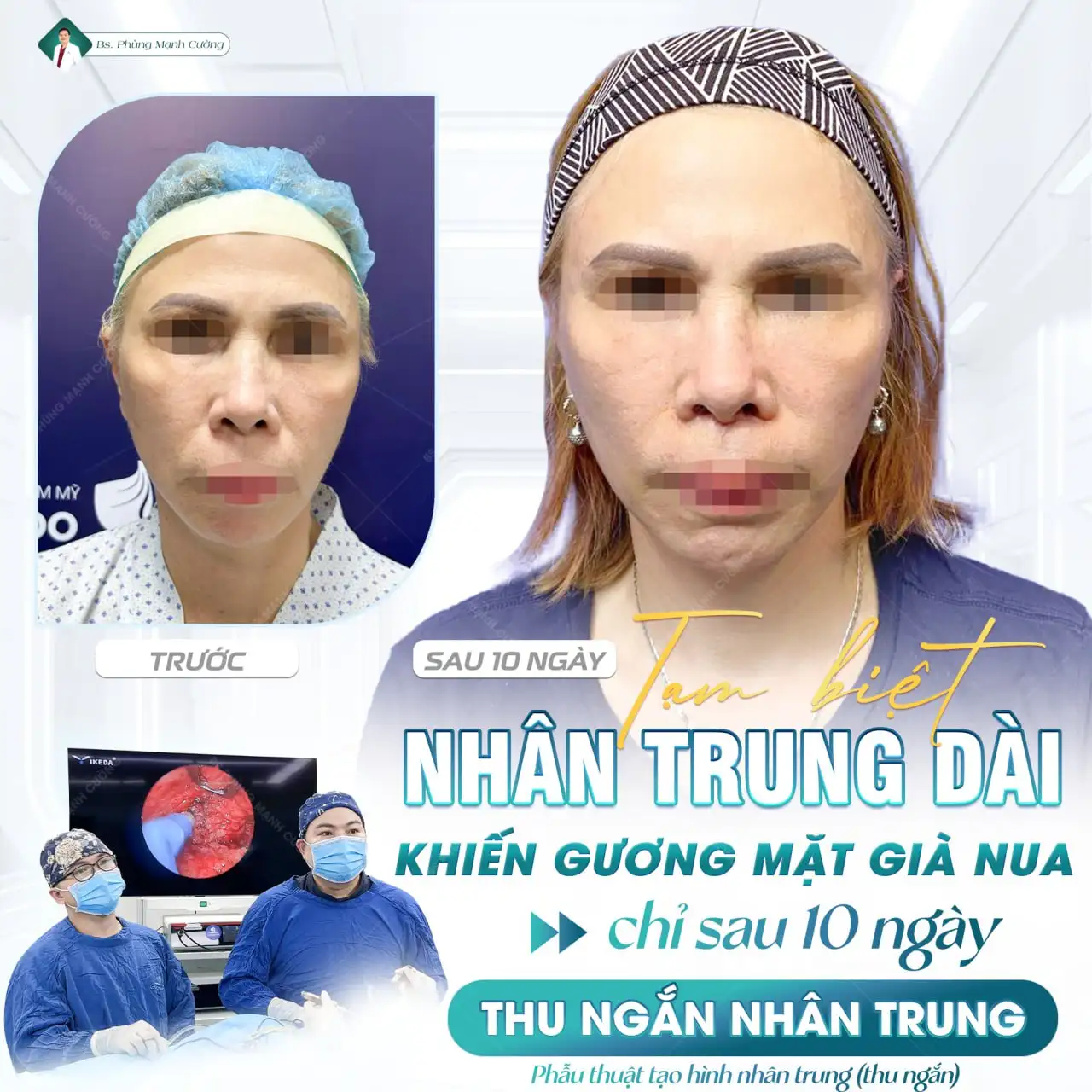 Lý do nên thu ngắn nhân trung