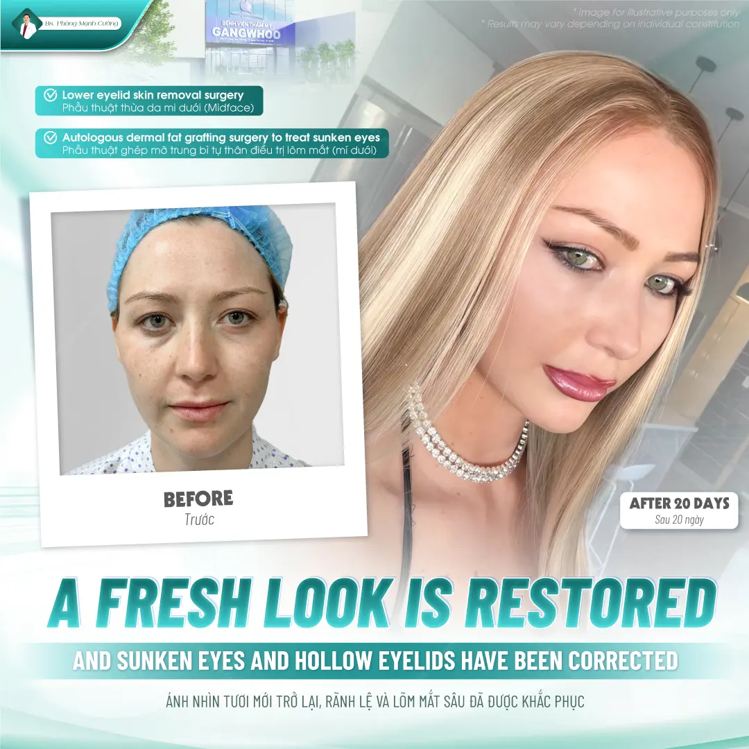 Kỹ thuật xóa nhăn đuôi mắt không cần phẫu thuật