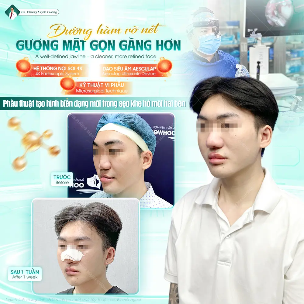 Các phương pháp điều trị sứt môi 