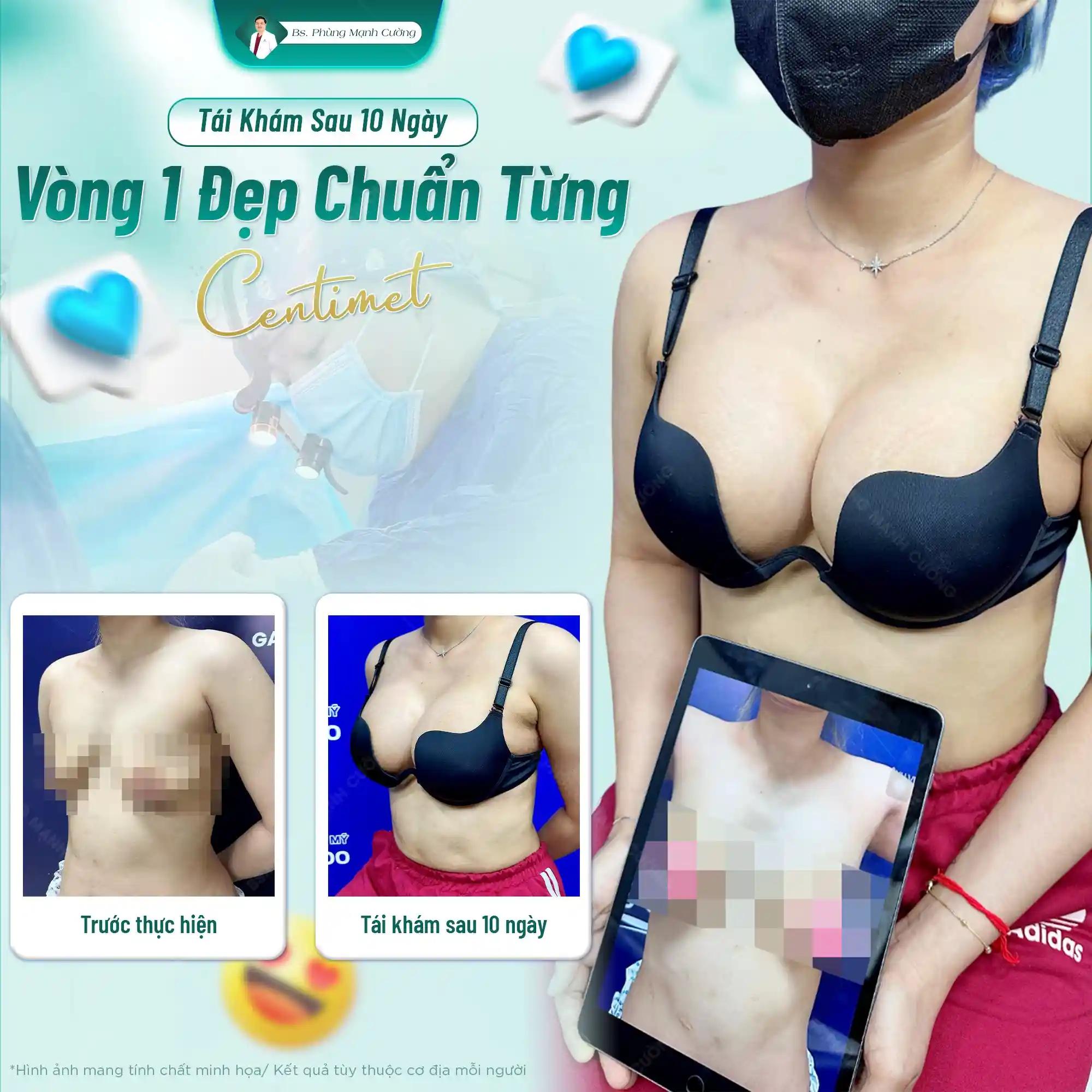 Ưu điểm của nâng ngực bằng mỡ tự thân