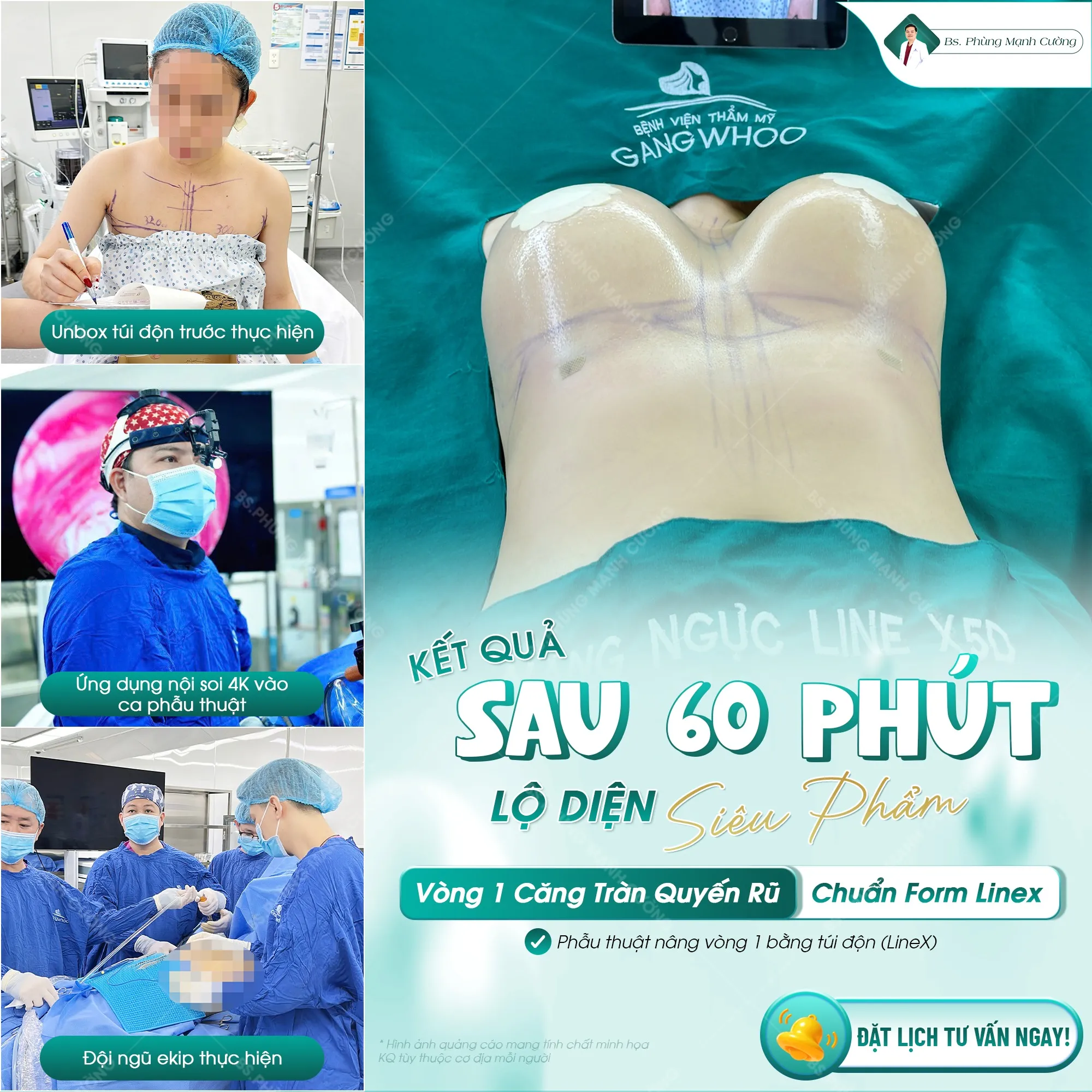 Chi phí nâng ngực bằng túi Sebbin siêu nhám dao động khoảng 110 triệu đồng