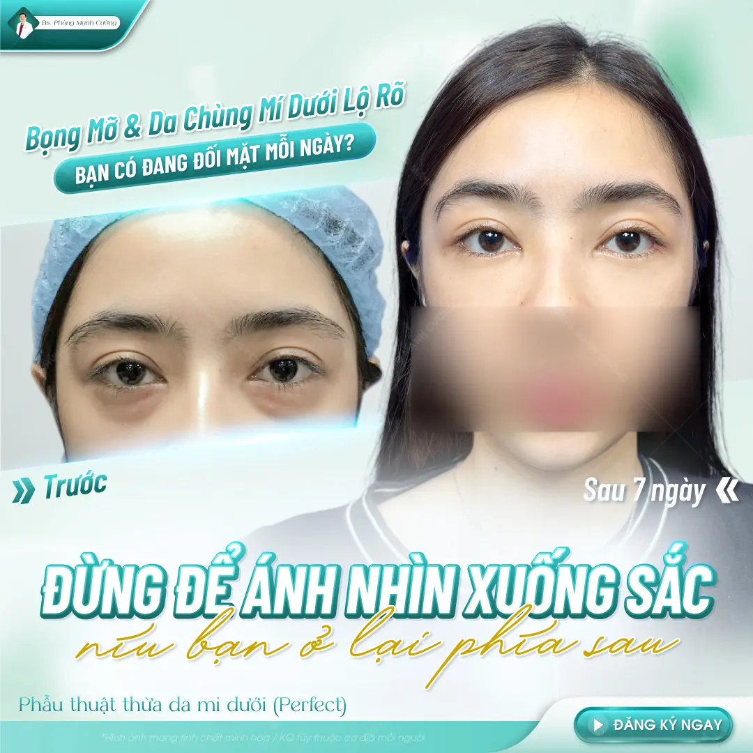 Chi phí cắt bọng mắt dưới dao động từ 7 đến 10 triệu đồng