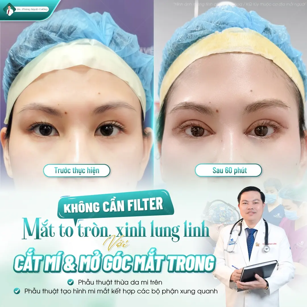 Cắt mí mini deep thường sẽ đẹp tự nhiên sau khoảng 7 đến 10 ngày