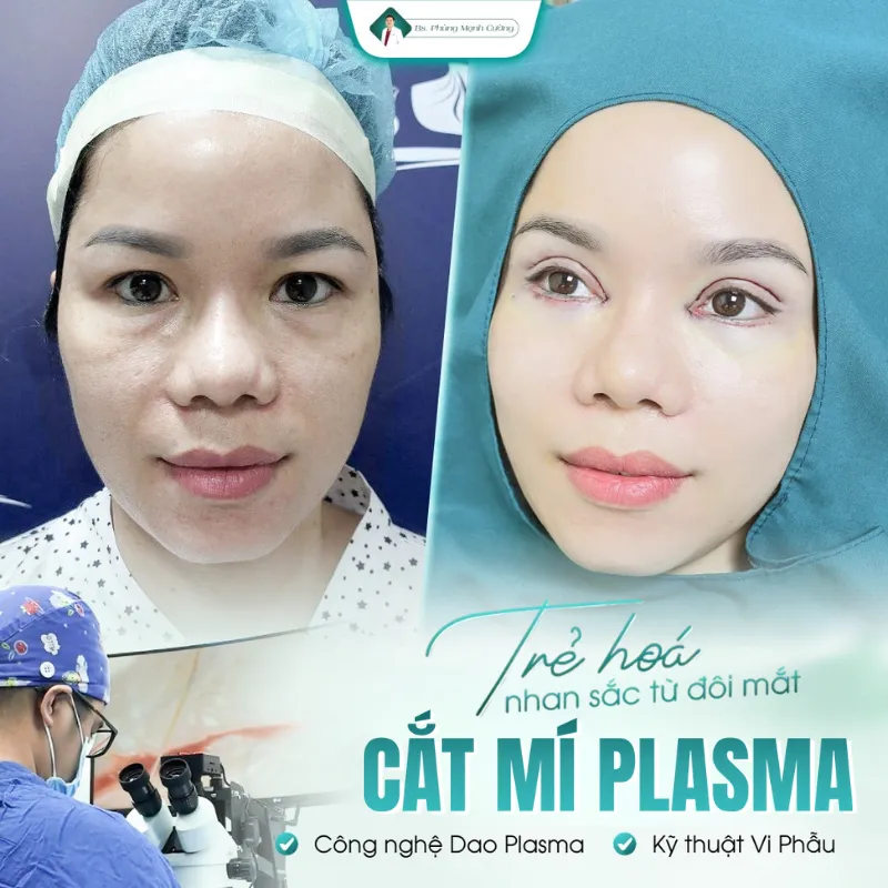 Cắt mí plasma là gì? Review cắt mí plasma có tốt không? 12 Cắt mí plasma phù hợp với những ai?